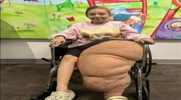 متلازمة كليبل ترينوناي تؤثر على نمو ساق «جاسمين» وتستدعي سلسلة جراحات لتقويم الحالة 1